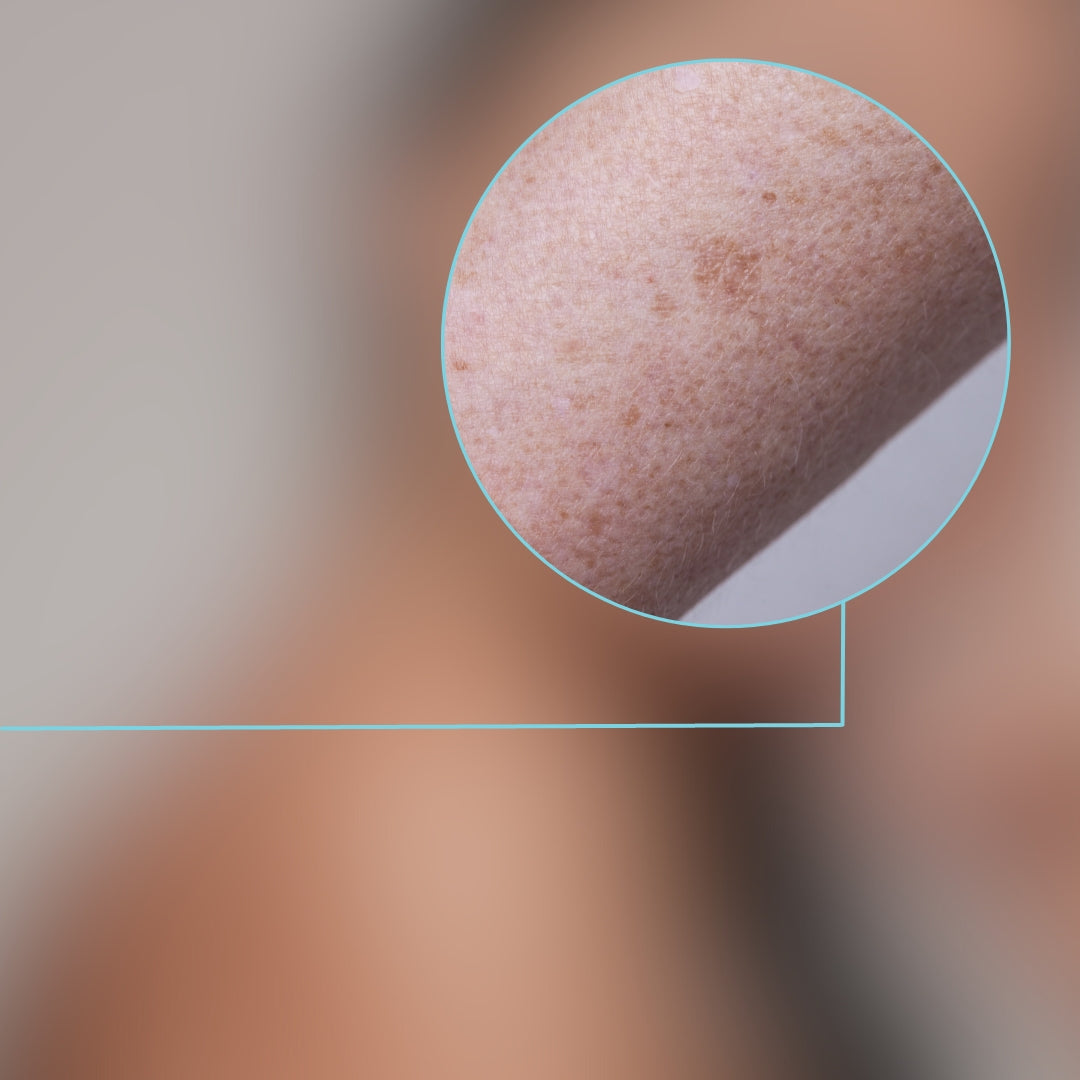 Unmasking the Mystery of Hyperpigmentation: Your Guide to Treating and Embracing Hyperpigmentation