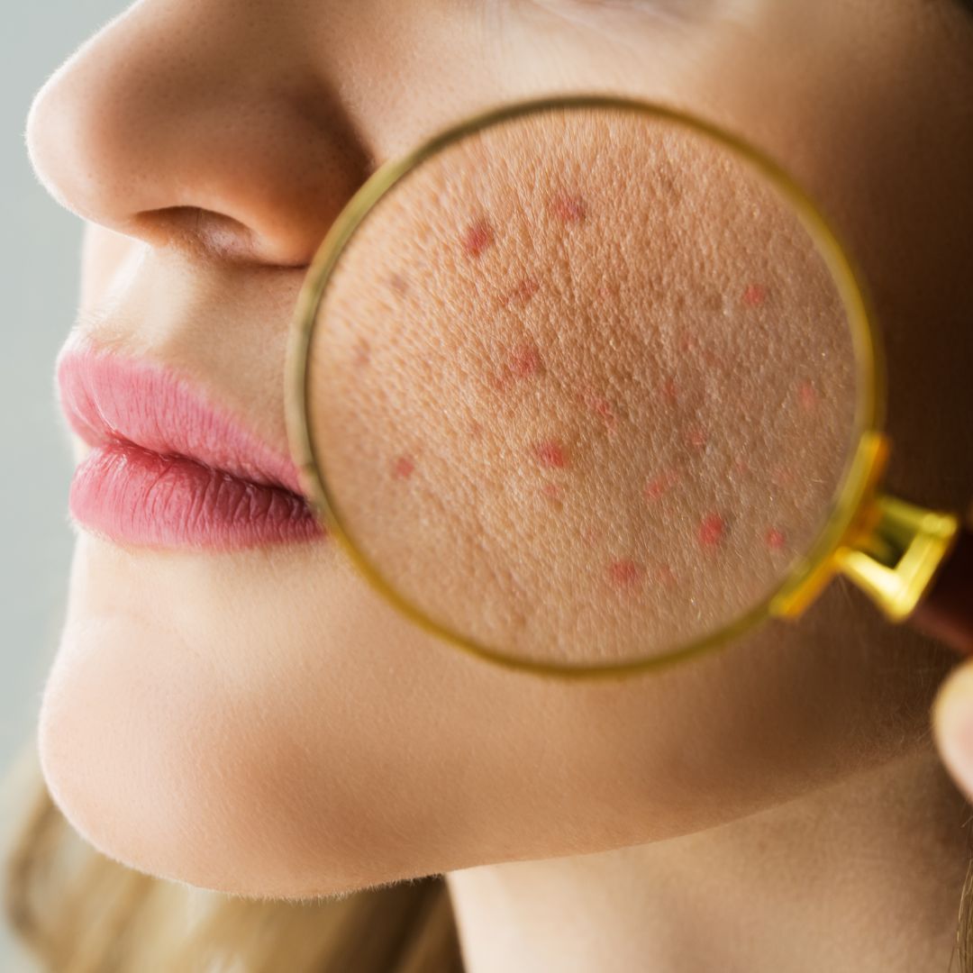 Navigating Adult Acne: Exploring the Different Types and Finding Your 