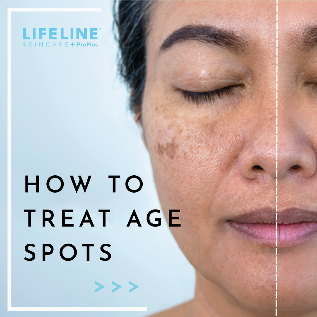 Treating Age Spots: Advanced Solutions for Radiant Skin