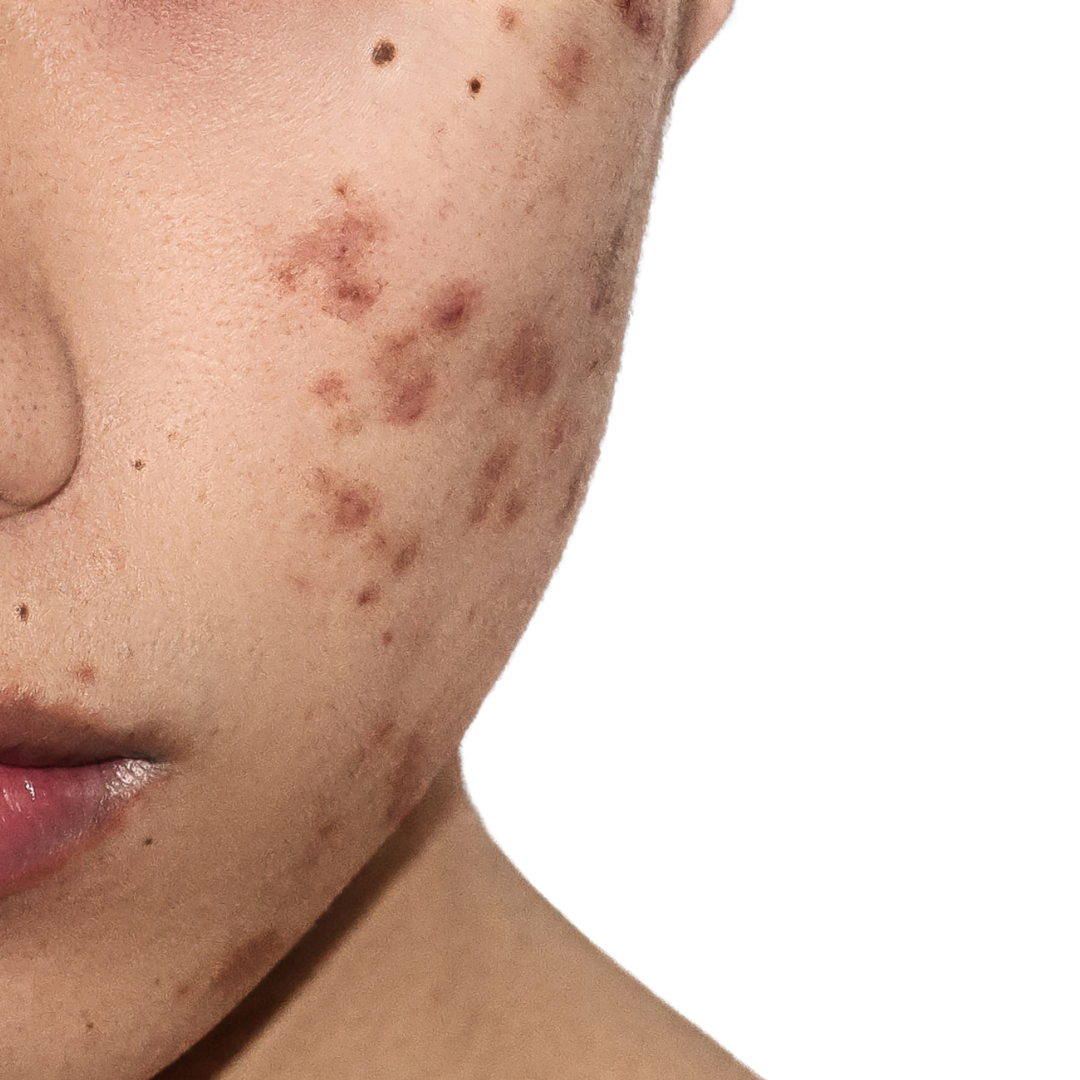 Understanding Acne Scarring: Causes and Effective Solutions
