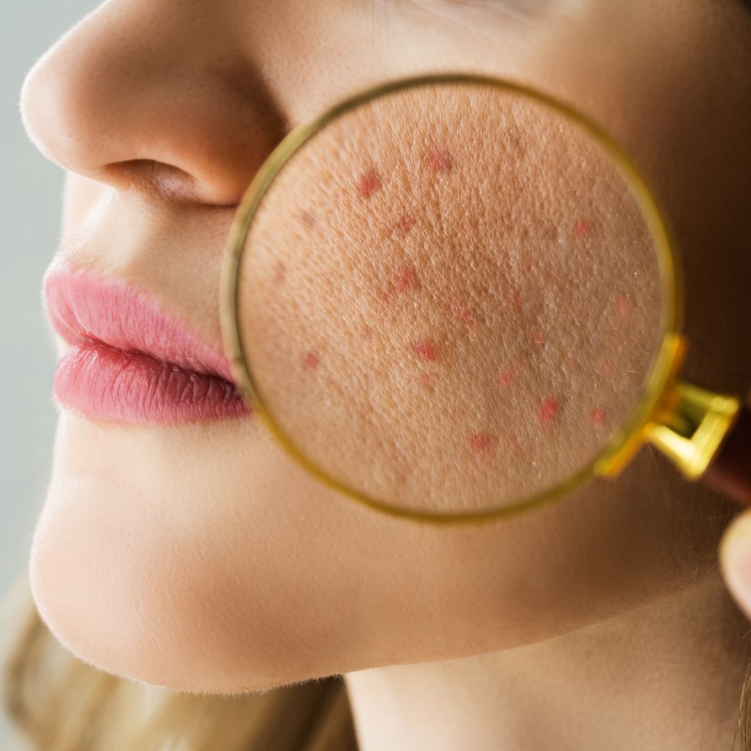 Navigating Adult Acne: Exploring the Different Types and Finding Your โ Lifeline Skin Care