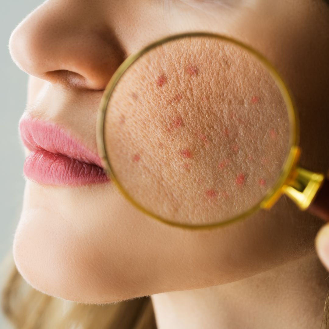 Navigating Adult Acne: Exploring the Different Types and Finding Your Solution